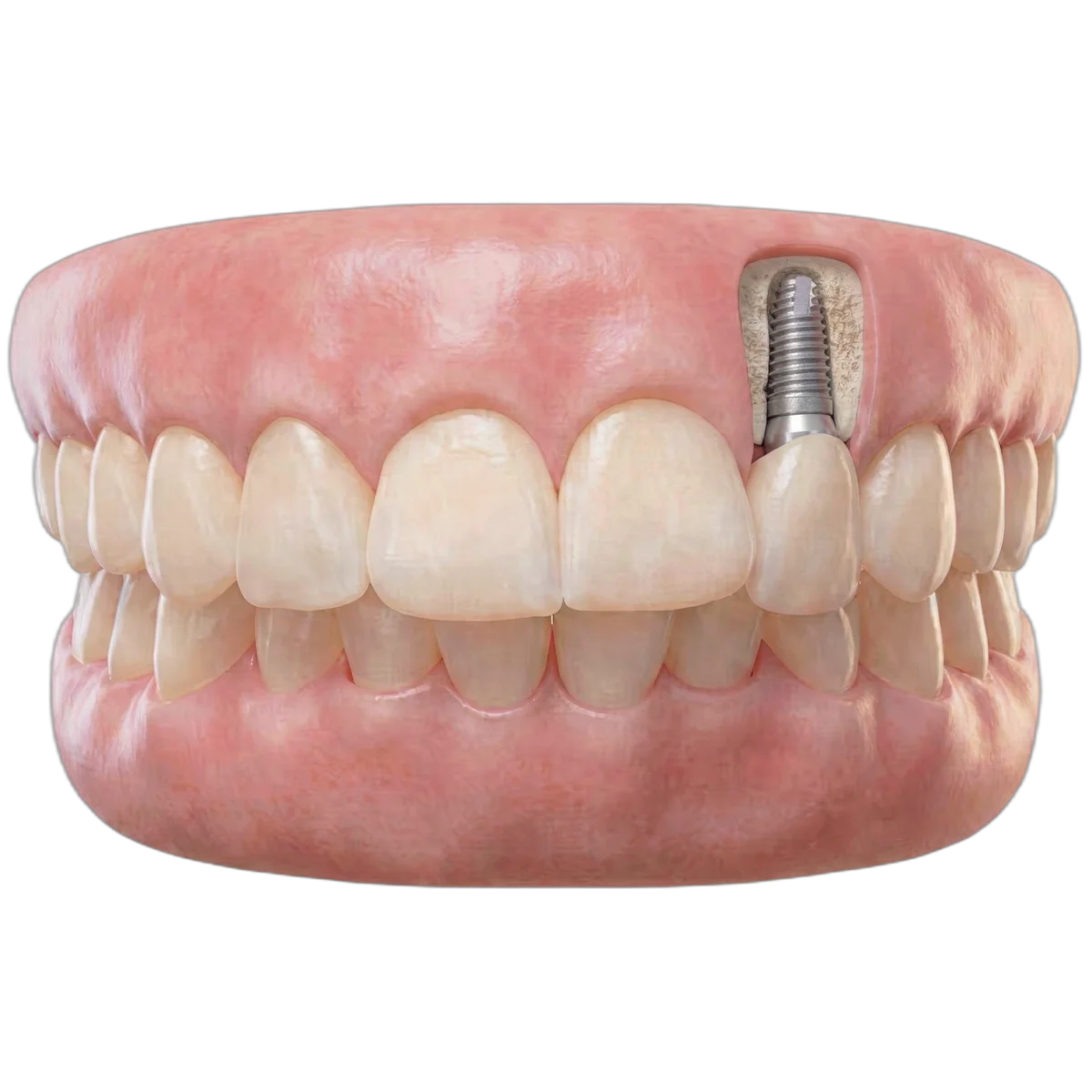 dental implants hero image